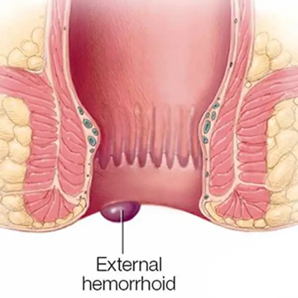 External Hemorrhoid