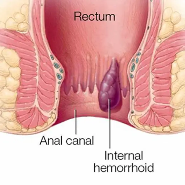Internal Hemorrhoid