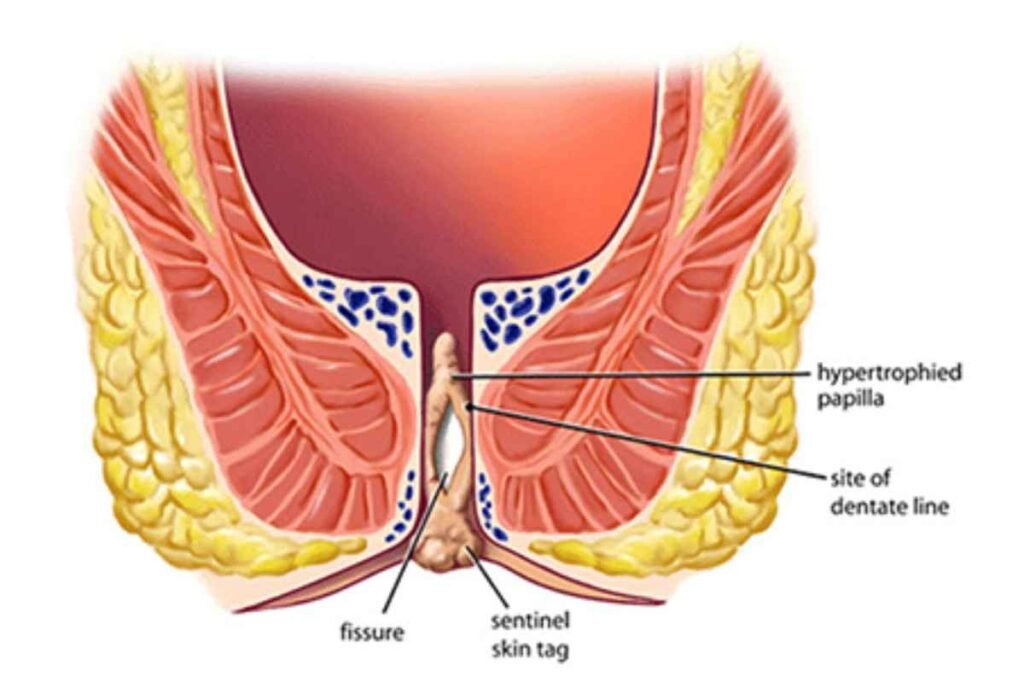 Ksharasutra treatment